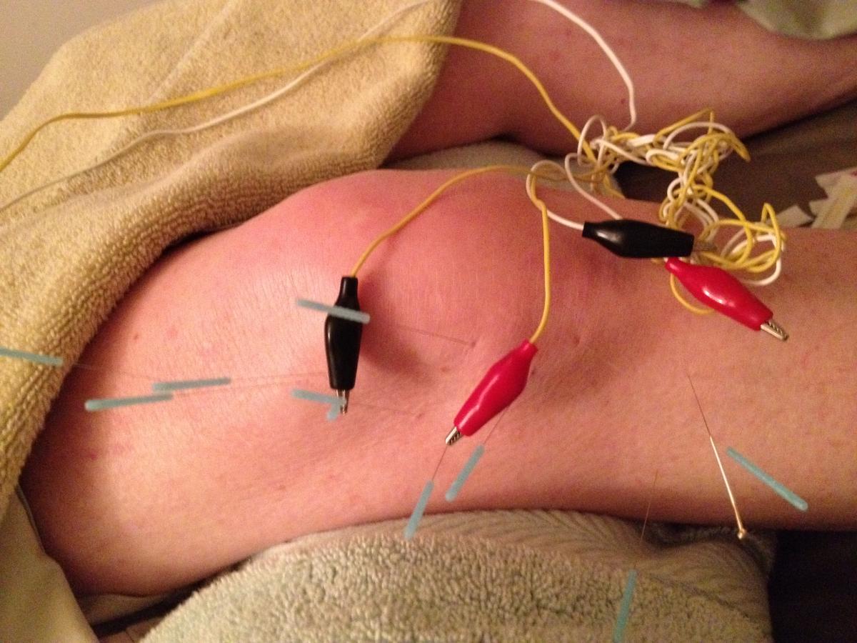 Electro-Acupuncture  Piedmont Acupuncture and Oriental Medicine